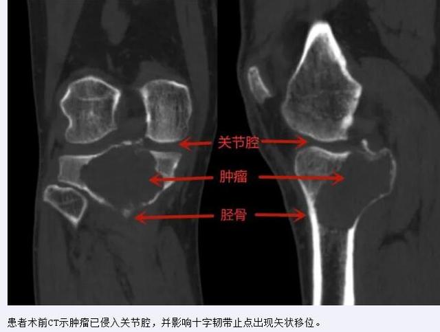 复发|山大齐鲁医院（青岛）为复杂骨巨细胞瘤患者保留自身膝关节