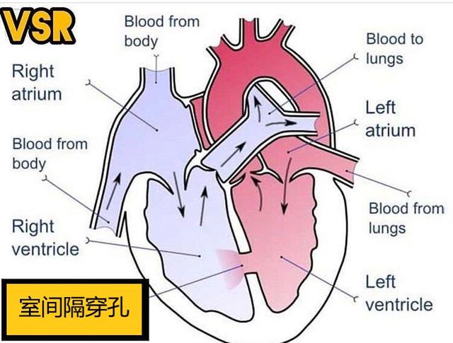 患者|心梗后一周内现呼吸不畅、血压低下，当心