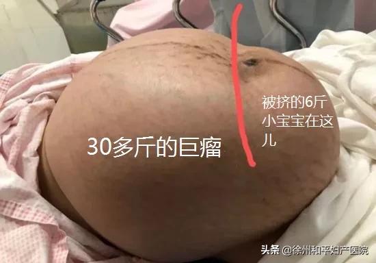 初夏薄凉|怀孕8个月从未产检，19岁女孩体内长30斤巨瘤