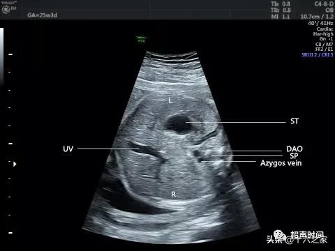 你的育儿经|胎儿下腔静脉缺如