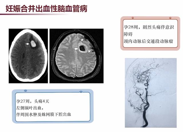 「超级宝妈」张馨：3类需要注意的妊娠合并神经系统疾病