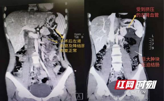 患者|“院长信箱”架起医患连心桥：患儿国内就医 慈母越南致谢