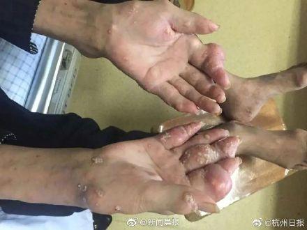 李先生|男子酗酒长满痛风石截瘫 医生：要是早些接受治疗就好了