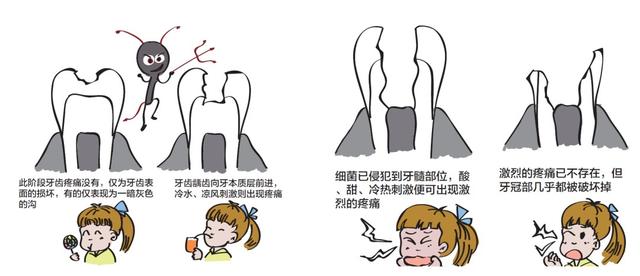 牙齿|不要小瞧了“虫牙”！预防它并不困难