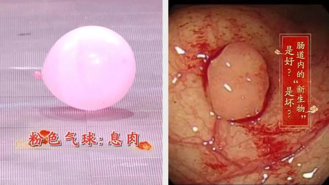 直肠癌|结直肠癌人数连年攀升，却少有人早发现！用对筛查标准，逆转肠癌