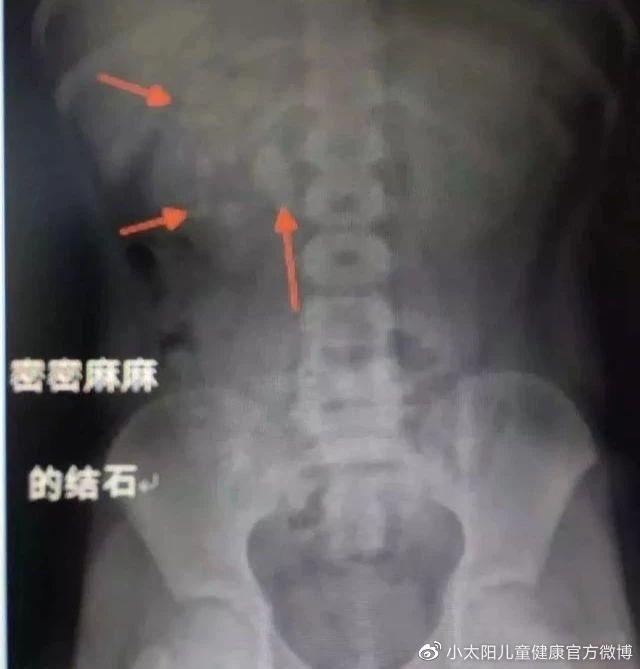 星空的浪漫|5月大女婴双肾长满结石：宝宝添加辅食，这些问题你都清楚吗？