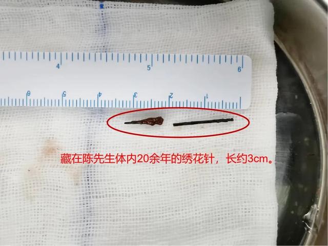 绣花针|小伙体内藏针20余年！顺德医生3小时手术“捞针”