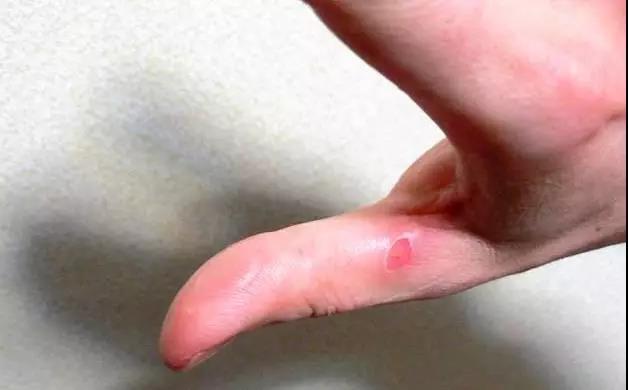 你的育儿经:被开水烫伤了怎么办?一分钟教你快速急救