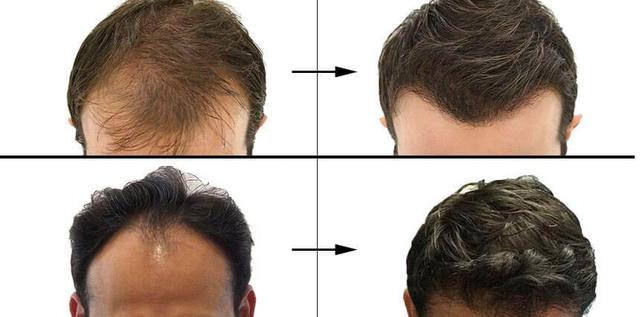 非那雄胺的真实有效率是多少（五位发友改善一年，终于告别稀疏）