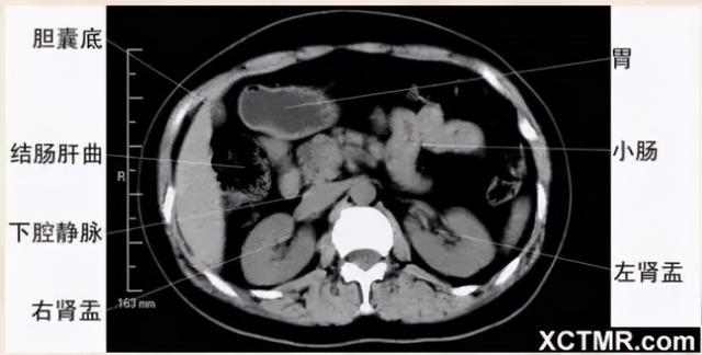 影像解剖：胸、腹部、盆腔CT解剖
