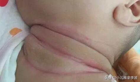 你的育儿经|小儿推拿李波：夏季宝宝淹脖子，发红又破皮怎么办？如何正确护理
