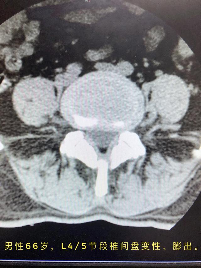 有一种“腰椎间盘突出症”，其实是颈椎病！