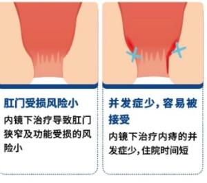 内痔|内镜下治疗痔疮，不做有“痔“一族