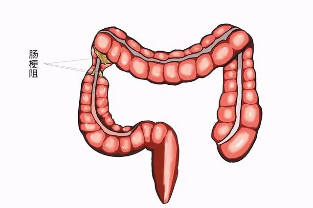 “放屁”和肠癌有关？什么样的屁可能是肠癌信号？医生有话讲
