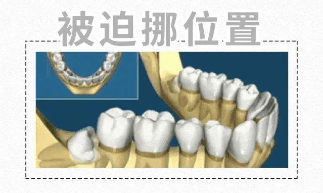 【科普】长了智齿该不该拔？这6类人别随意拔，严重时可危及生命.....