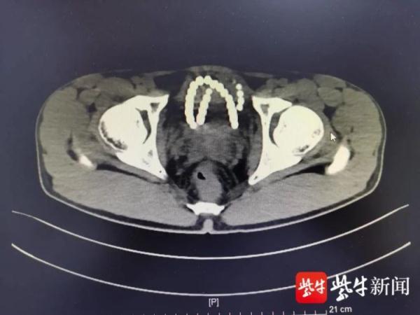 膀胱|小伙膀胱里有串“项链”，自己塞的……