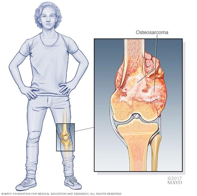 骨肉瘤Osteosarcoma