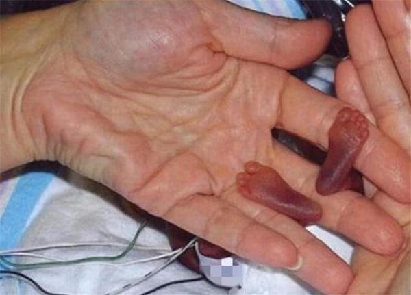 小树丫■世界上“最小的婴儿”，出生时1斤不到，现已长成挺拔少年
