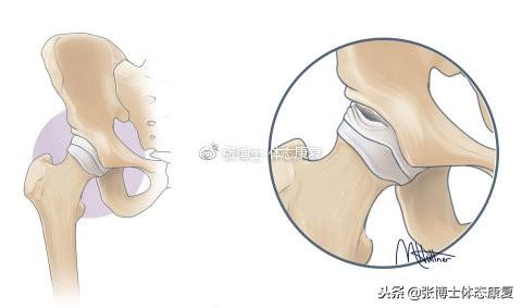 疼痛|「译文分享」弹响髋综合征的成因分析与康复方法