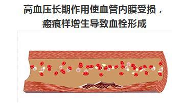 高血压|高血压是这样一步一步毁掉一个人的……