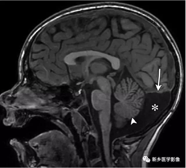 大脑中线处常见的25种疾病