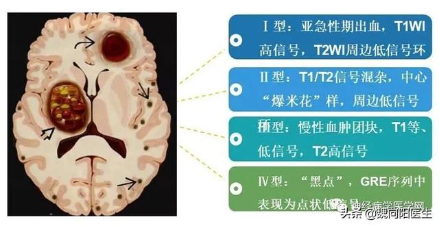 海绵状血管瘤不是真肿瘤，解读海绵状血管瘤治疗指南。