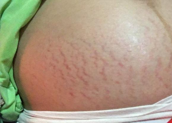 你的育儿经▲同样是怀孕当妈，为何有些孕妈不长妊娠纹？主要和孕妇的妈妈有关