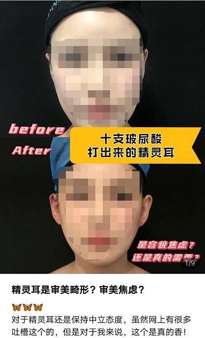 精灵|网红“精灵耳”风靡 专家：正常耳朵往畸形了整