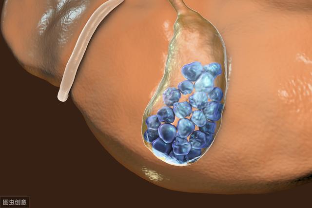 肠癌|胆囊切除真的会增加肠癌发病风险吗？让数据来回答这个问题