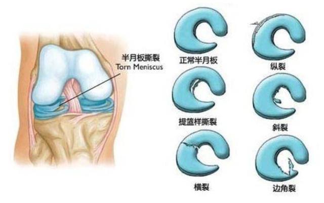 膝盖疼痛原因多，针对性康复治疗最有效