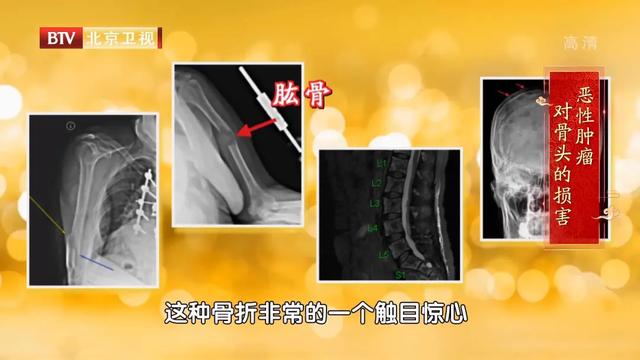 骨髓瘤|这种恶性肿瘤会伪装，误诊率50%！两管血、一管尿，早早检测