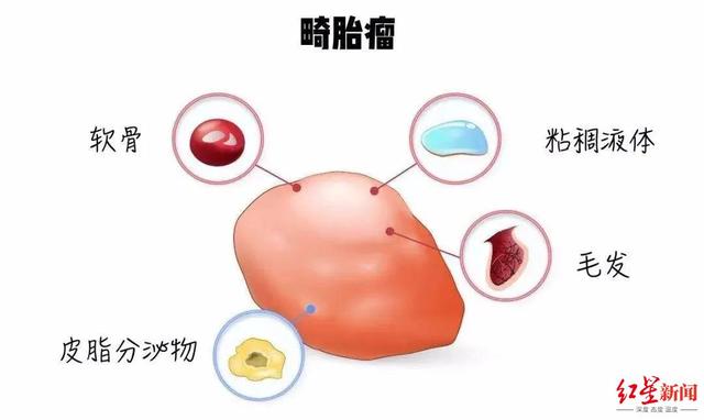 畸胎瘤|男子“怀胎”45年,医生手术取出5斤重畸胎瘤
