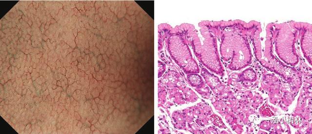 肠上皮化生的放大内镜与病理图像 | 内镜集锦