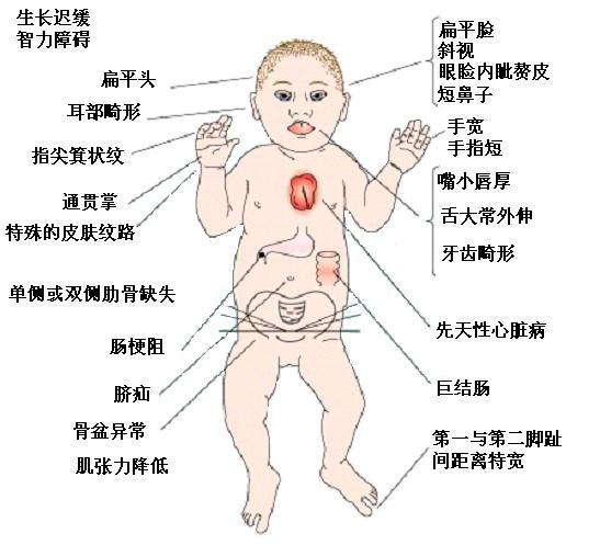 「超级宝妈」宝宝出生双手断掌,婆婆以为大富大贵,结果医生的话让人傻了眼