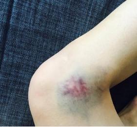 超级宝妈|宝宝摔伤后怎么做才能不留疤？这些护理方法每位家长都要Get到