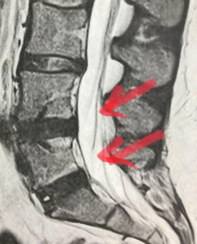 椎间盘|年纪轻轻就得了腰椎间盘突出可怕么？该怎么保养腰椎？