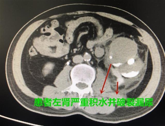 剧烈|陪孙子上跆拳道课，爷爷模仿拳脚用力过猛伤了肾