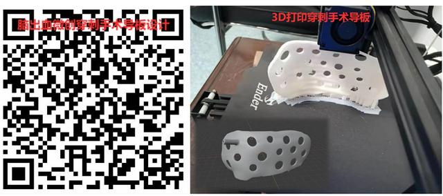 手术|湘西州人民医院：3D数字医学工程技术精准治疗抗凝药物相关性脑出血