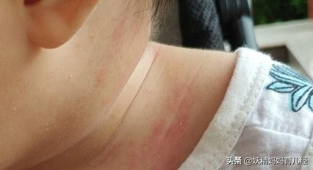 你的育儿经：宝宝长痱子只能擦痱子粉？15个不外传护理技巧，比痱子粉还管用