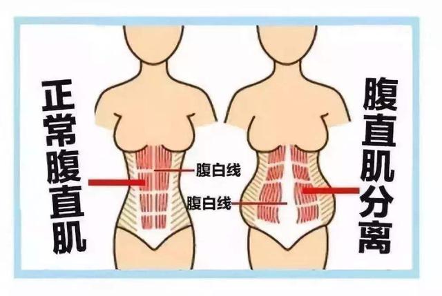 你的育儿经■【女性健康】高龄产妇产后腹直肌严重分离，在家该如何自测恢复？