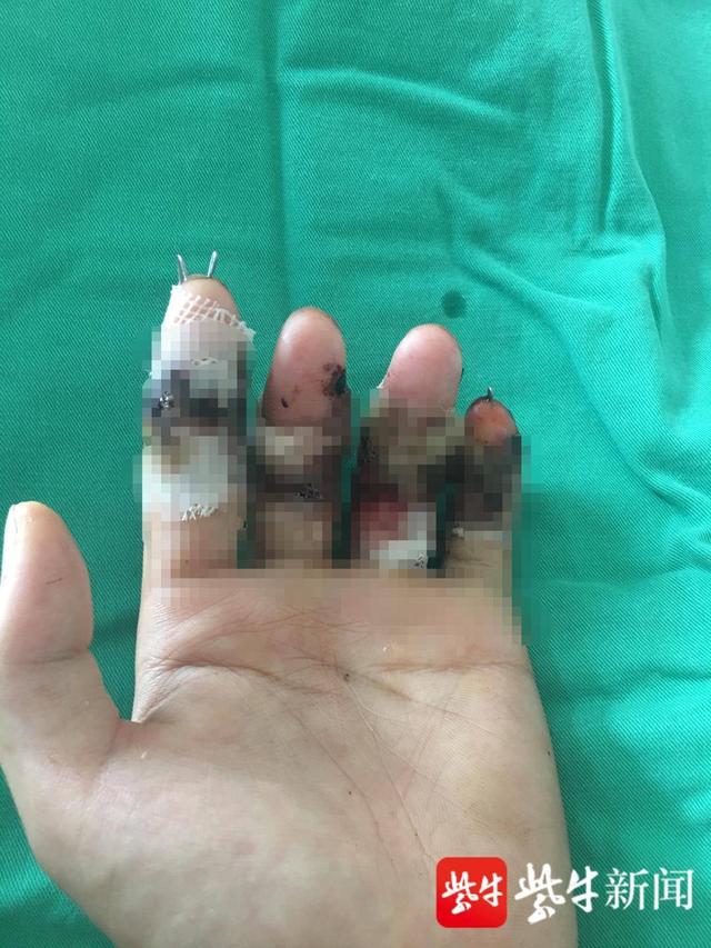 手指|1岁娃玩具切断手指、16岁勤工俭学剪断手指...... 暑期断指事件“高发”