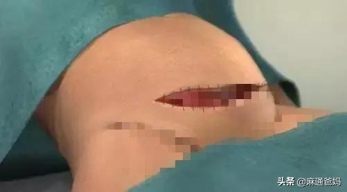 『超级宝妈』剖腹产很容易的，产妇说疼都是矫情，这句话遭受产妇怒斥