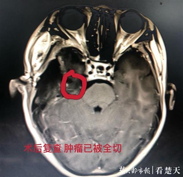 婆婆3个月来疼得不敢洗脸，原是脑瘤增大引发三叉神经痛