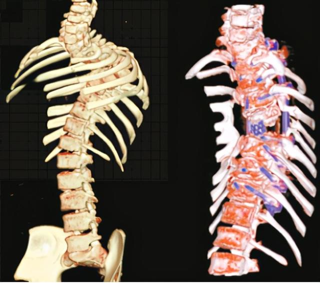 11岁男孩胸椎后突畸形骨折，多技术护航成功矫形