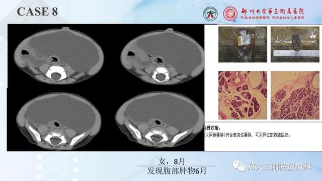 儿童腹部囊性病变诊断思路分析