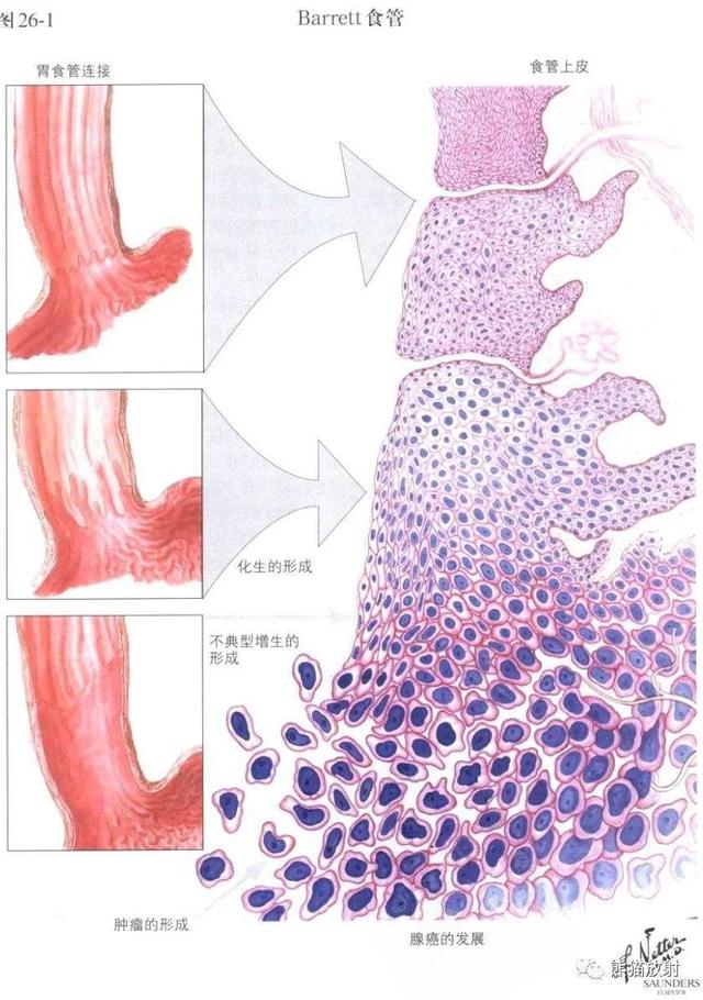 食管|科普知识丨巴雷特食管，和武器同名的它，真那么可怕吗？
