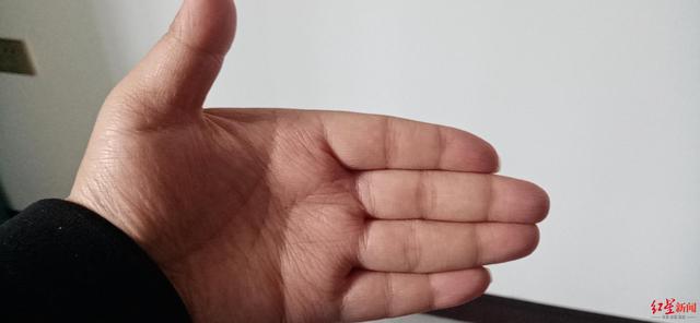 交感|双手出汗多也是病？22岁的他有一双“水手”，能让手机进水……