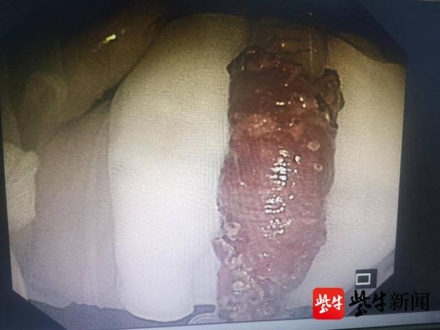 病变|食管粘膜“瘤变”了！“医林绝技”成功挽救，耄耋老人迎新生