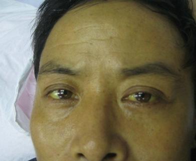 三甲教授:8成肝癌发现就是晚期, 一旦眼睛,鼻子2个变化, 别拖了