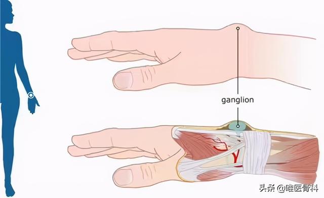 腱鞘囊肿会癌变吗？关于「腱鞘囊肿」，你要知道的 5 点